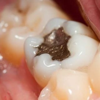 Eksik dişleri olanlar dikkat! Bu tehlikeler sizi bekliyor