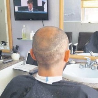 Yanlış saç ekimine tazminat davası